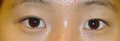 Edmund Kwan, MD blepharoplasty after — New York, NY