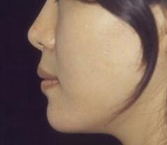 Edmund Kwan, MD rhinoplasty after — New York, NY
