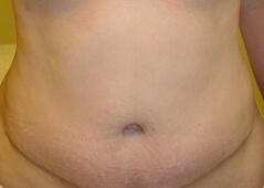 Edmund Kwan, MD tummy tuck after — New York, NY