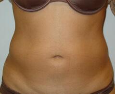Edmund Kwan, MD liposuction after — New York, NY