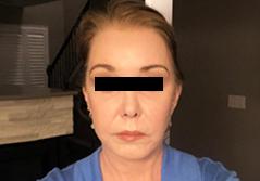 Edmund Kwan, MD facelift after — New York, NY