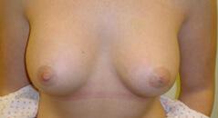 Edmund Kwan, MD breast augmentation after — New York, NY