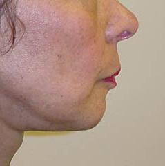 Neck Lift after at Edmund Kwan, MD in New York, NY