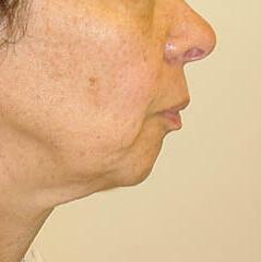Neck Lift before at Edmund Kwan, MD in New York, NY
