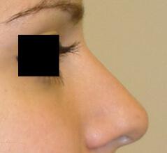 Edmund Kwan, MD rhinoplasty after — New York, NY
