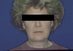 Edmund Kwan, MD facelift after — New York, NY