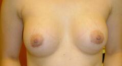Edmund Kwan, MD breast augmentation after — New York, NY