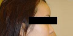 Brow Lift after at Edmund Kwan, MD in New York, NY