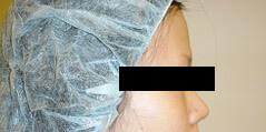 Brow Lift before at Edmund Kwan, MD in New York, NY