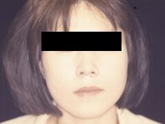 Fat Transfer after at Edmund Kwan, MD in New York, NY