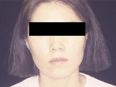 Fat Transfer before at Edmund Kwan, MD in New York, NY