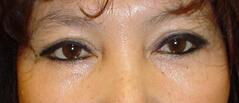 Edmund Kwan, MD blepharoplasty after — New York, NY