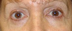 Edmund Kwan, MD blepharoplasty after — New York, NY