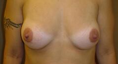 Edmund Kwan, MD breast augmentation after — New York, NY