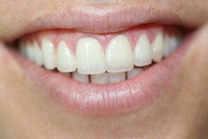 Pearl Cosmetic and Family Dentistry smile makeover after — San Diego, CA