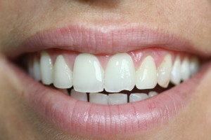 Smile Makeover before at Pearl Cosmetic and Family Dentistry in San Diego, CA