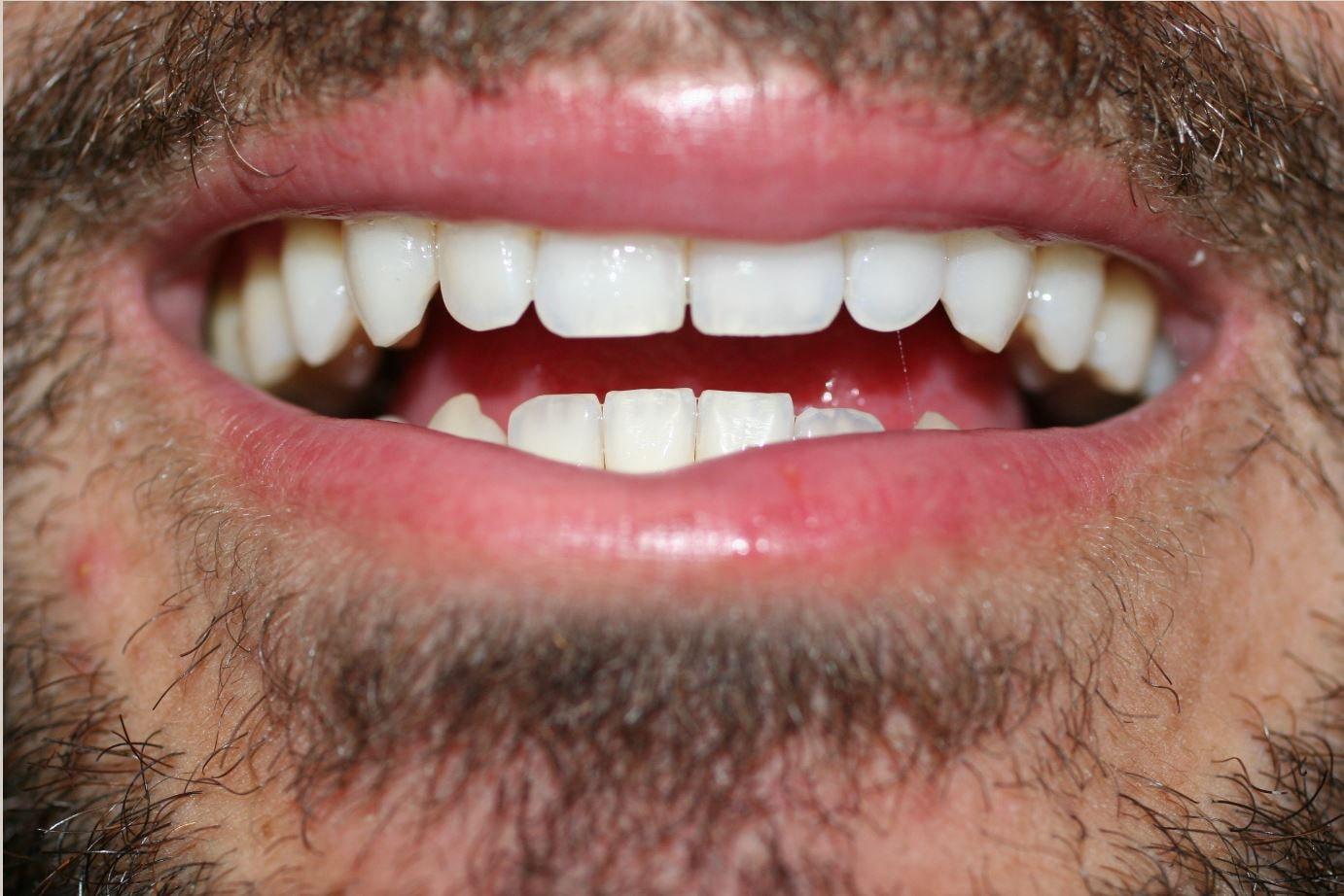 Pearl Cosmetic and Family Dentistry smile makeover after — San Diego, CA