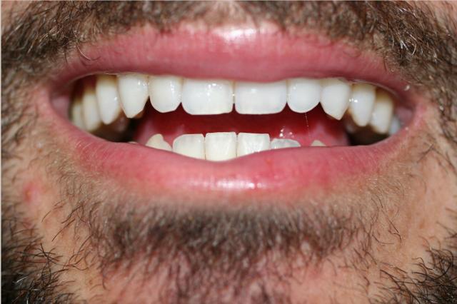 Smile Makeover after at Pearl Cosmetic and Family Dentistry in San Diego, CA