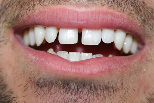 Smile Makeover before at Pearl Cosmetic and Family Dentistry in San Diego, CA