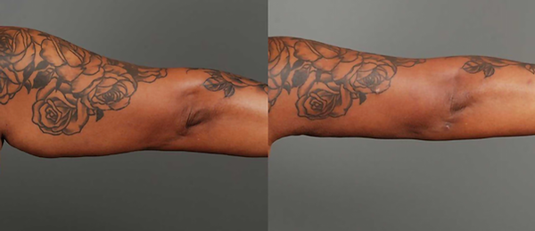 Vigam Medical Spa and Laser result — Hillsboro, OR