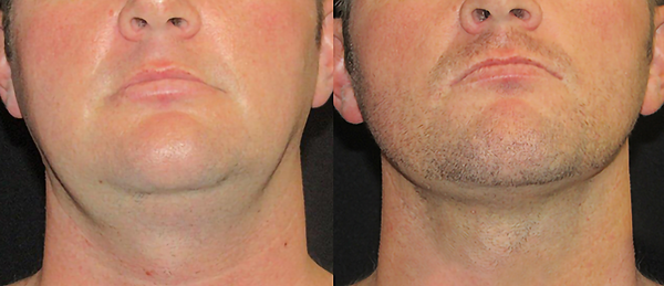 Vigam Medical Spa and Laser result — Hillsboro, OR