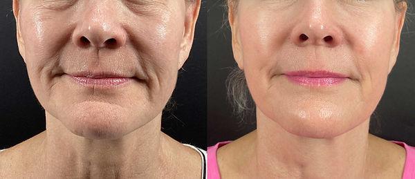 Vigam Medical Spa and Laser skin tightening result — Hillsboro, OR