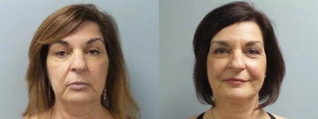 Deep Plane Facelift result at Main Line Institute of Plastic Surgery in Villanova, PA