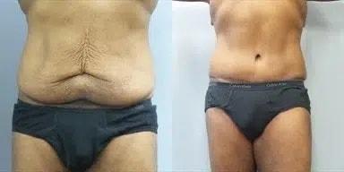 Main Line Institute of Plastic Surgery tummy tuck result — Villanova, PA