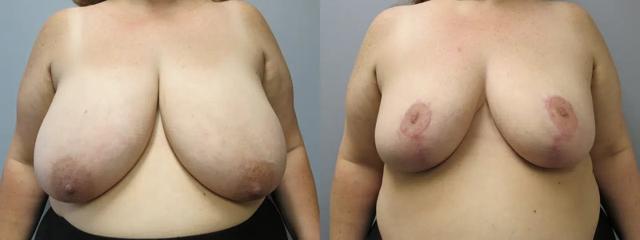 Breast Reduction result at Main Line Institute of Plastic Surgery in Villanova, PA
