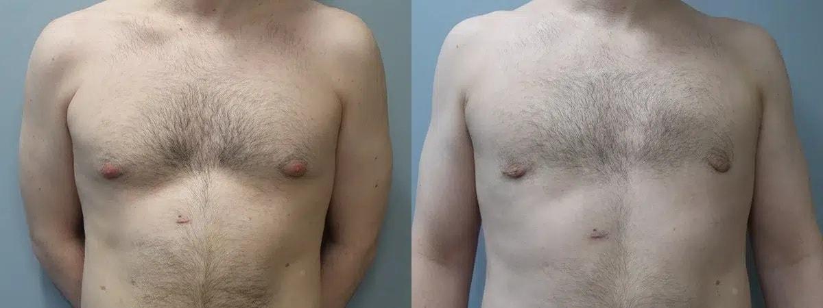 Main Line Institute of Plastic Surgery gynecomastia result — Villanova, PA