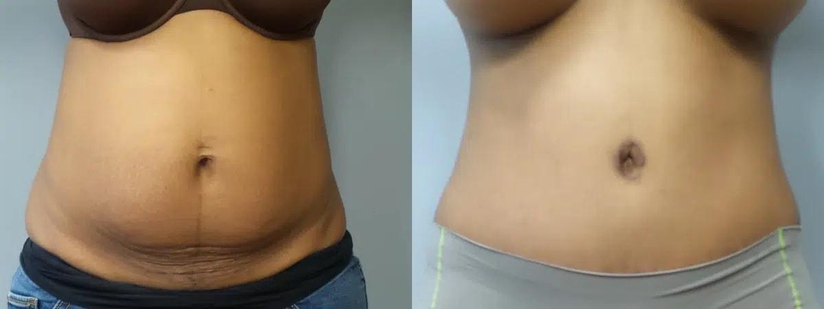Main Line Institute of Plastic Surgery tummy tuck result — Villanova, PA