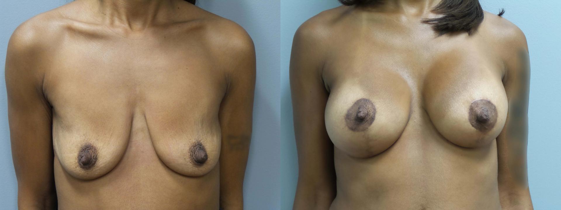 Main Line Institute of Plastic Surgery breast lift result — Villanova, PA