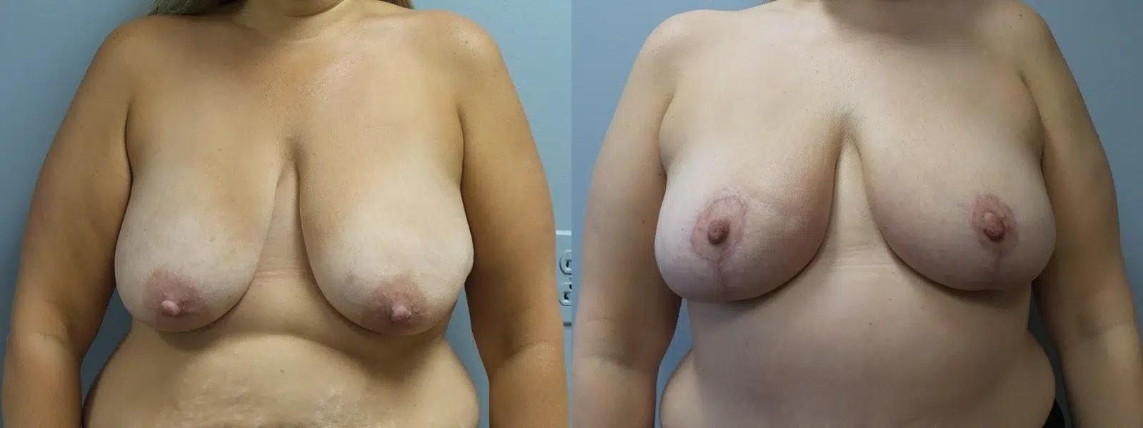 Main Line Institute of Plastic Surgery breast lift result — Villanova, PA