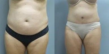 Main Line Institute of Plastic Surgery tummy tuck result — Villanova, PA
