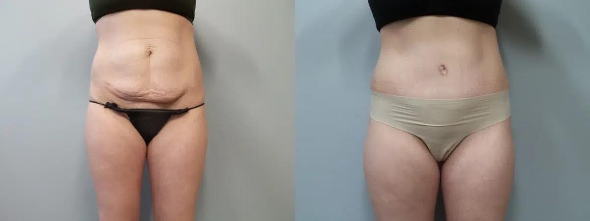Main Line Institute of Plastic Surgery tummy tuck result — Villanova, PA