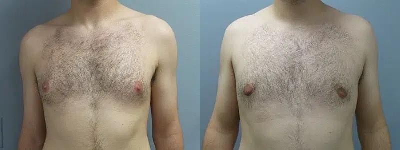 Main Line Institute of Plastic Surgery gynecomastia result — Villanova, PA