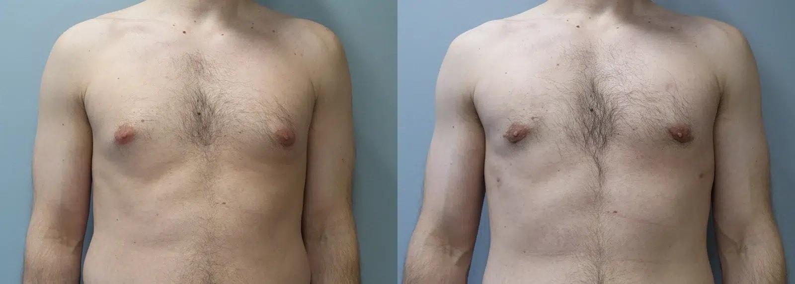 Main Line Institute of Plastic Surgery gynecomastia result — Villanova, PA