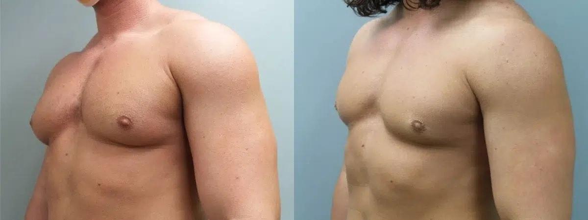 Main Line Institute of Plastic Surgery gynecomastia result — Villanova, PA