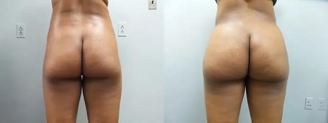 Brazilian Butt Lift result at Main Line Institute of Plastic Surgery in Villanova, PA