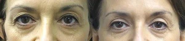 Blepharoplasty result at Main Line Institute of Plastic Surgery in Villanova, PA