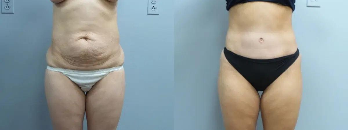 Main Line Institute of Plastic Surgery tummy tuck result — Villanova, PA