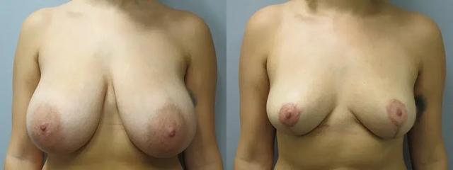 Breast Reduction result at Main Line Institute of Plastic Surgery in Villanova, PA