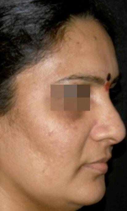 Ananya Aesthetics after — Pasadena, CA