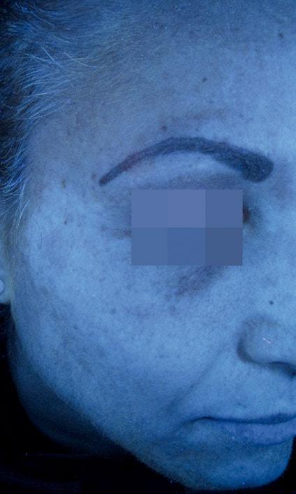 Ananya Aesthetics after — Pasadena, CA
