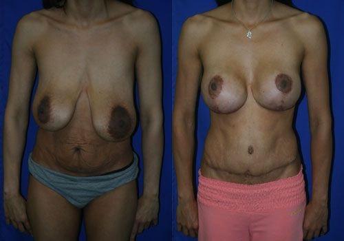 Steven K Struck, MD mommy makeover result — Atherton, CA