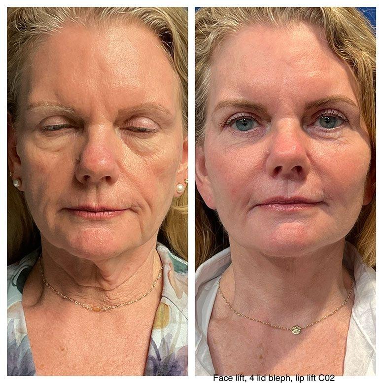 Steven K Struck, MD facelift result — Atherton, CA
