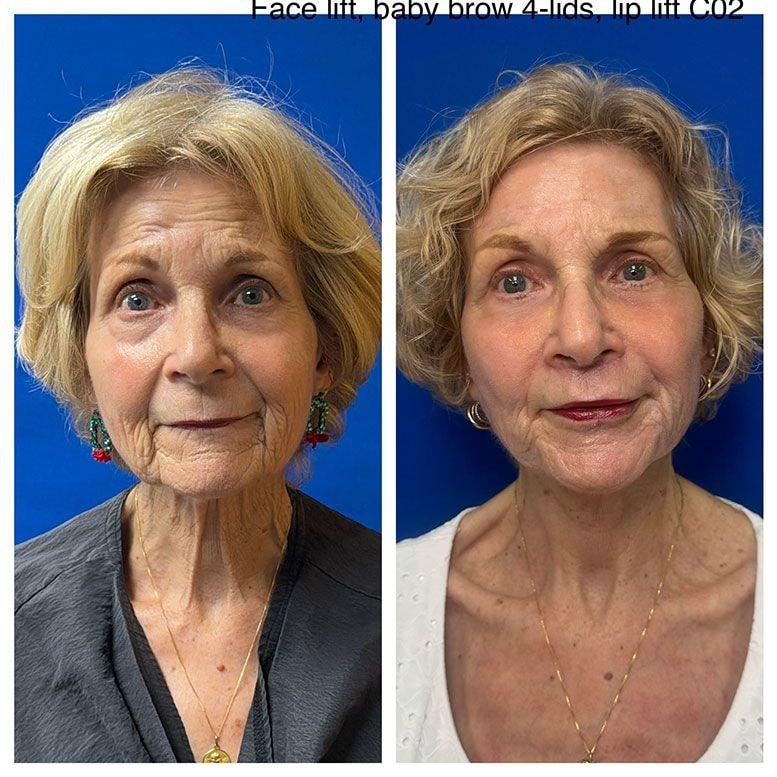 Steven K Struck, MD facelift result — Atherton, CA
