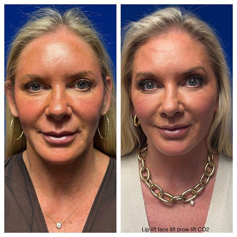 Steven K Struck, MD facelift result — Atherton, CA