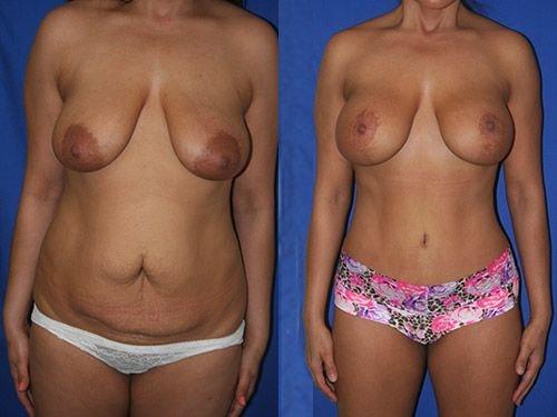 Steven K Struck, MD mommy makeover result — Atherton, CA