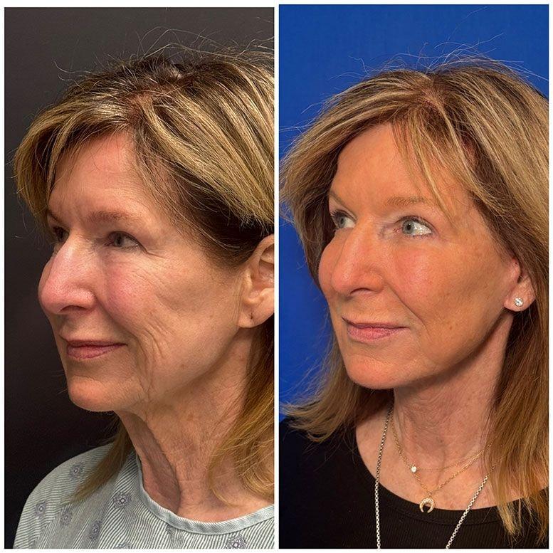 Steven K Struck, MD facelift result — Atherton, CA